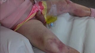 Flushing My Bladder with 3-way Catheter