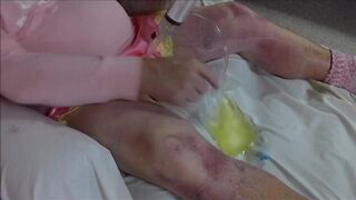 Flushing My Bladder with 3-way Catheter - 4 image