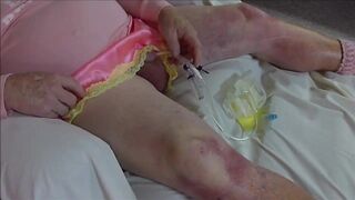 Flushing My Bladder with 3-way Catheter